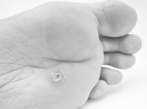 Viral Verrucae Removal Romford