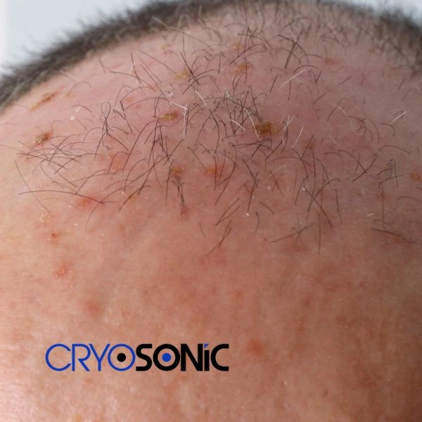 Access Seborrhoeic Keratosis removal from the comfort of your own home! Call us today in Romford