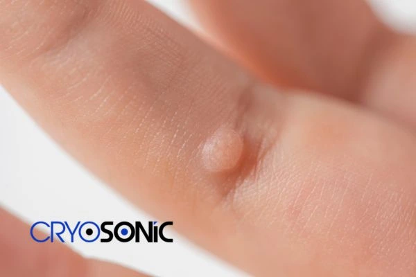 Contact Cryosonic today to learn more about us Romford now! Romford