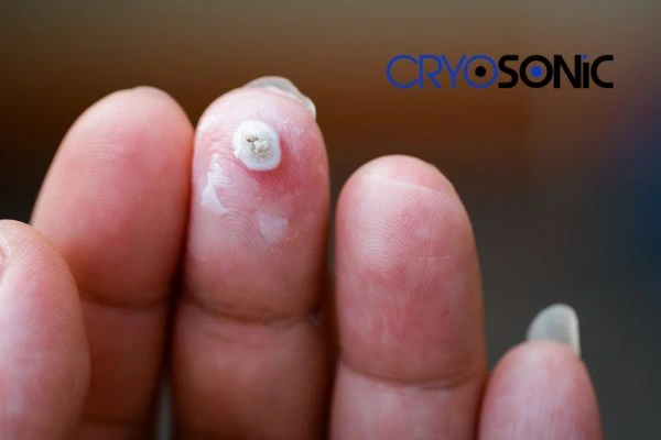 Learn more about us Romford at Cryosonic. Book in today! Romford