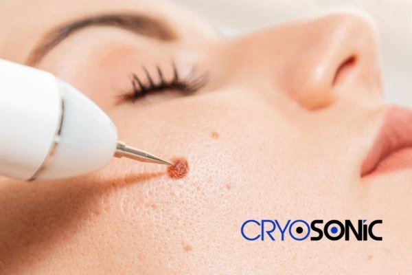 why choose us at Cryosonic for blemish removal? Find out more now Romford
