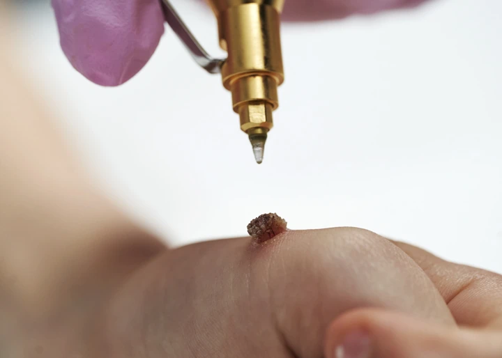 Cryopen For Children Bristol Romford