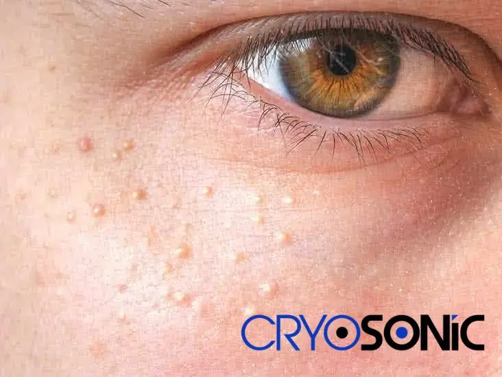 Cryosonic&rsquo;s CryoPen Approach to Milia Removal Romford Romford