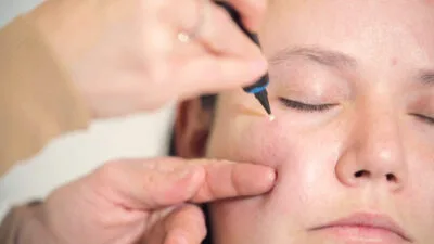 Aftercare Advice Following Milia Removal in Romford