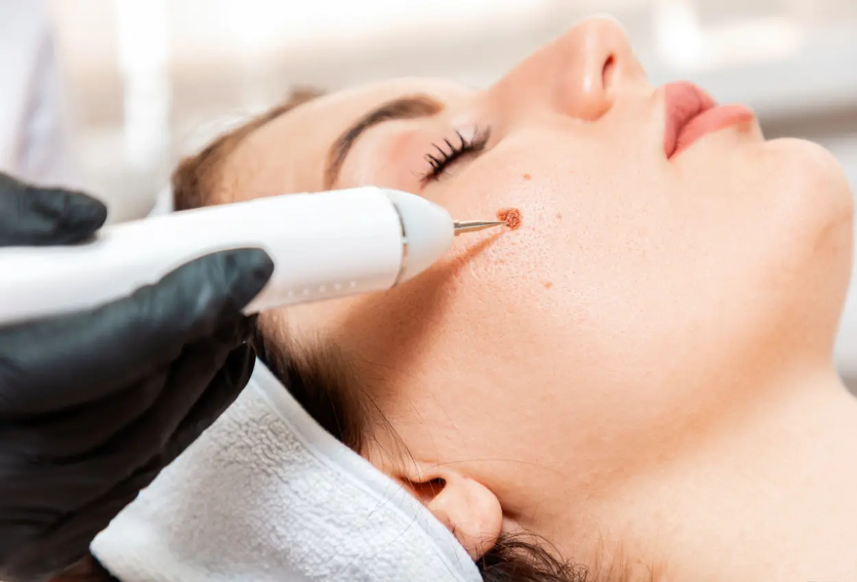 Frequently Asked Questions About Multiple Cryotherapy Treatments Romford