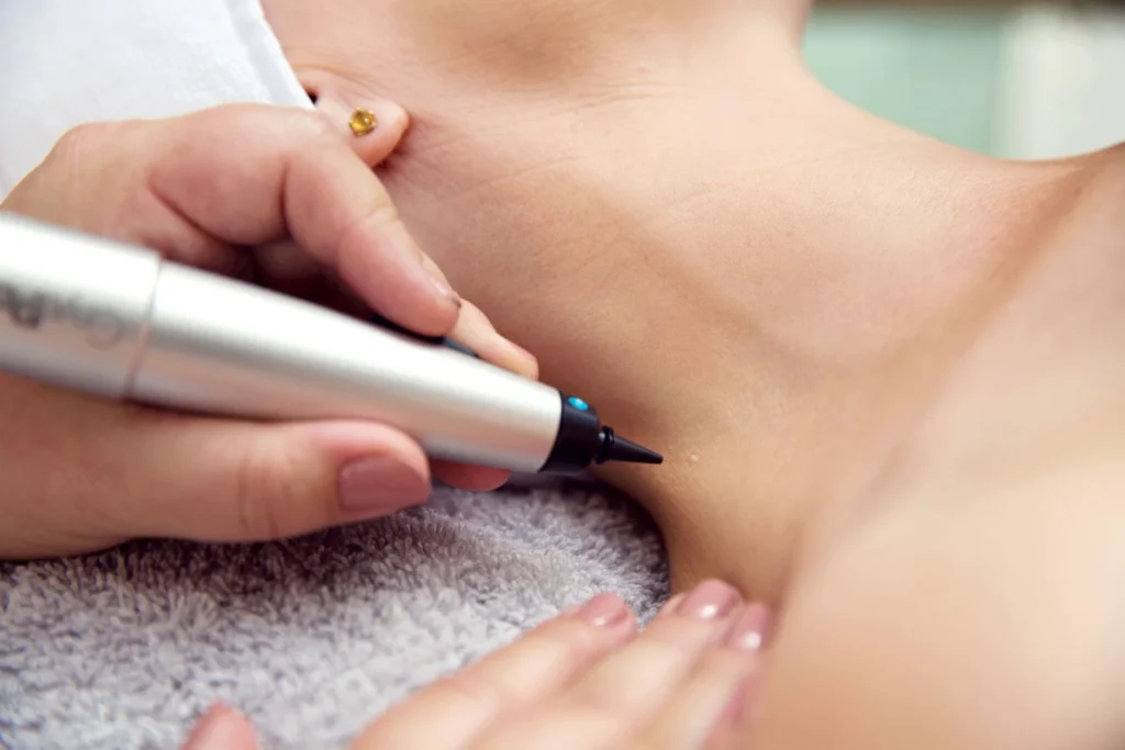 CryoPen Romford precisely treating Molluscum Contagiosum lesions, showing safe and effective removal for faster healing by Cryosonic Romford