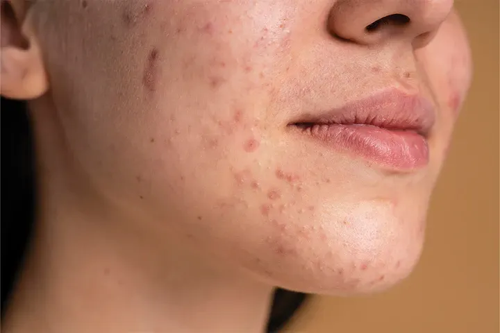 CryoPen precisely removing Skin Tags (fibroepithelial polyps), showing safe and effective treatment for smoother, clearer skin Romford