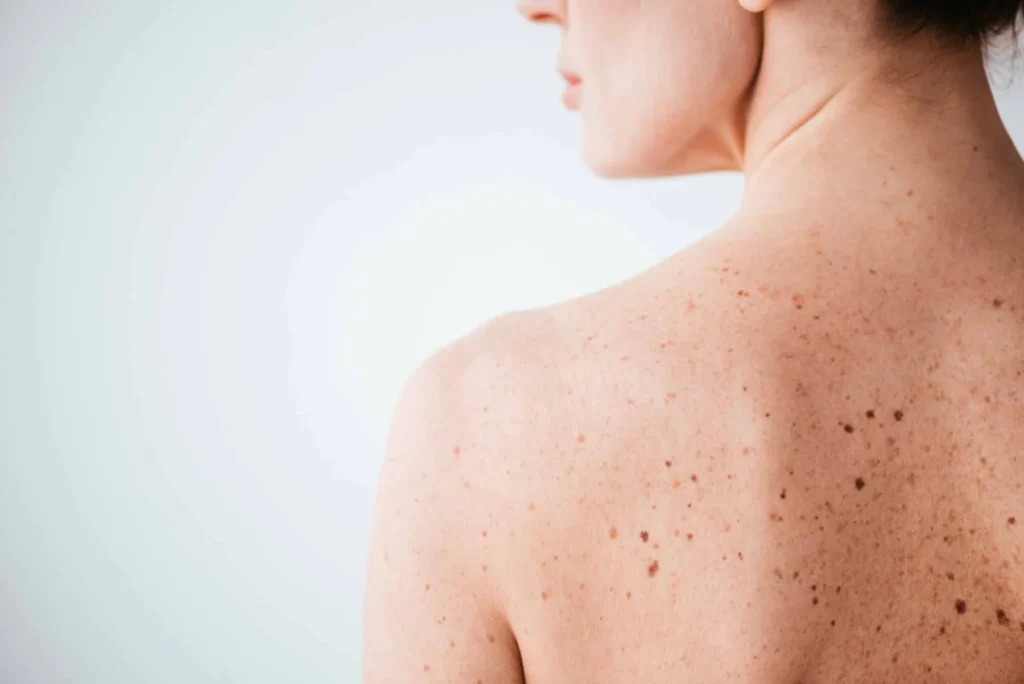 Sun Damage : Understanding UV Effects and Skin Repair Options Romford