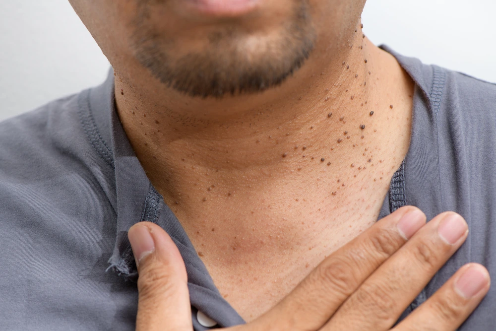 image of dermatofibroma removal Romford Romford