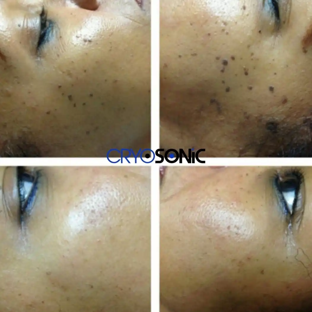 Why Skin Shows Pigmentation After Treatment Romford