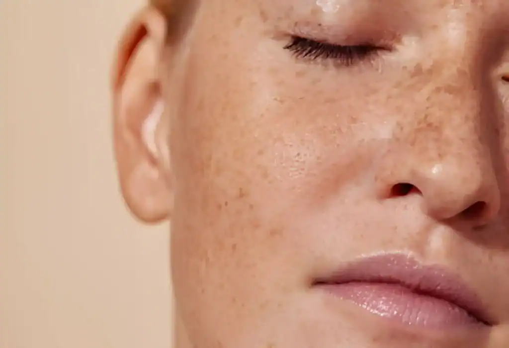 Ephelides Treatment Romford