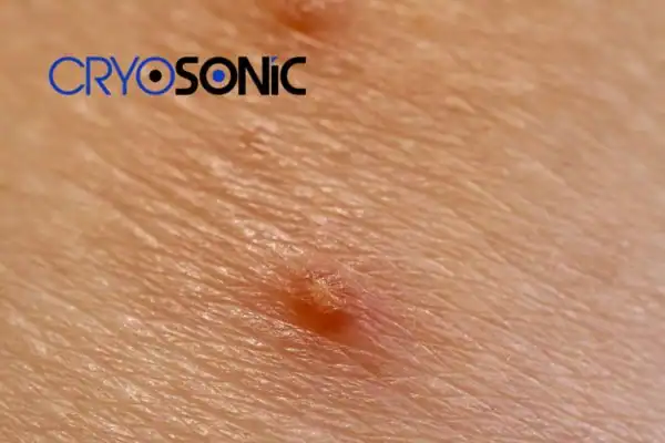Molluscum Contagiosum Treatment Romford Romford