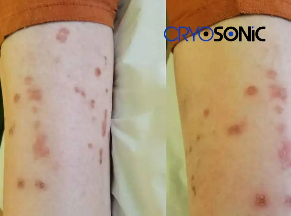 Recovery and Aftercare for Porokeratosis Treatment Romford Romford