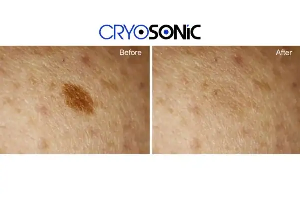 Before and after age spot removal Romford Romford