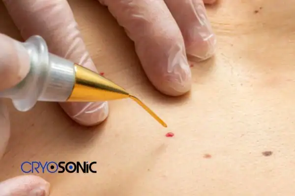 Image of cherry angioma removal Romford Romford