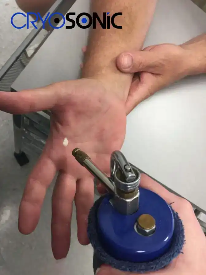 Temperature Differences: OTC vs Medical-Grade Cryotherapy Romford